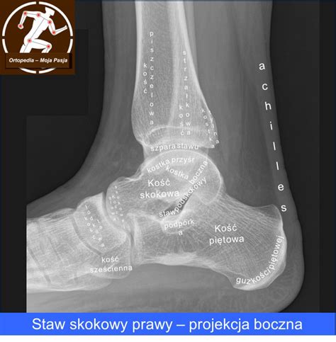 Rtg Staw Skokowy Projekcja Boczna Michał Drwięga Lekarz Ortopeda