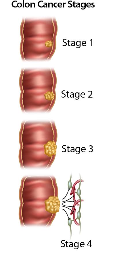 About Colorectal Cancer: Symptoms, Risk Factors, Diagnosis & Stages ...