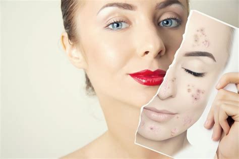 Adult Onset Acne Case Study And Clinical Perspective