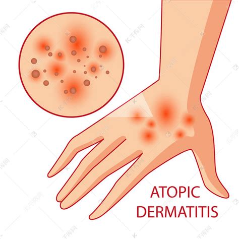特应性皮炎的插图。过敏症。皮肤病学。炎症素材图片免费下载 千库网