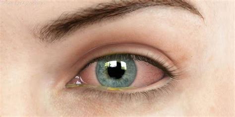 red eye eyecare network