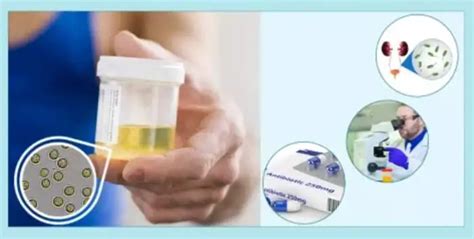 Pus Cells In Urine Causes Symptoms Ranges And Treatment