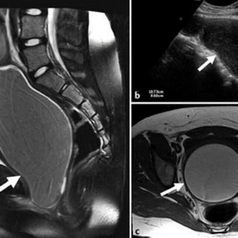 6 Year Old Female Patient With Adnexal Torsion A Transabdominal