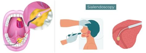 What Is Submandibular Sialadenitis Dr Sharad Ent