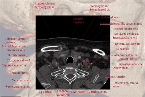 Subclavian Artery