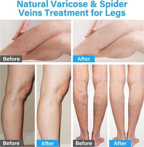 Updateclassic Tratamiento De Venas Varicosas Para Piernas Crema Para Venas Varicosas Mejora La