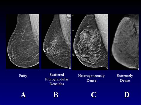 What Should You Know About Breast Density Breast Cancer Awareness