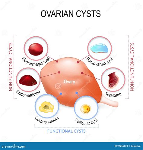 ovarian cyst hair teeth 4