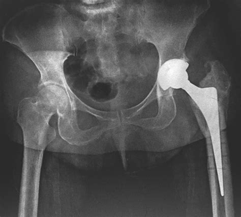 Conjoint Removal Of Hip Screwfemur Head During Hip Replacement After