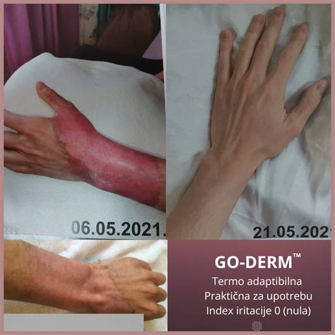 Krema Za Regeneraciju Kože Posle Opekotina