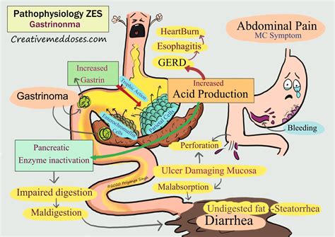 Zollinger-Ellison syndrome pathophysiology - Creative Med Doses
