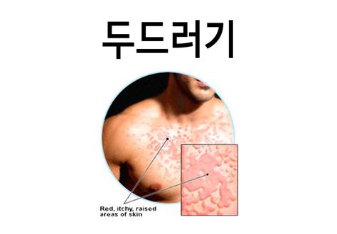 피부가려움증 원인 온몸에 두드러기가 네이버 블로그