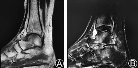 MRI imaging of ankle joint 2 months after operation shows: The ankle ...