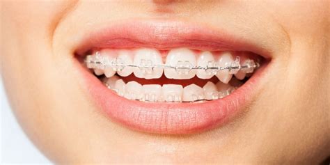 jenis jenis behel gigi   dijumpai alldent