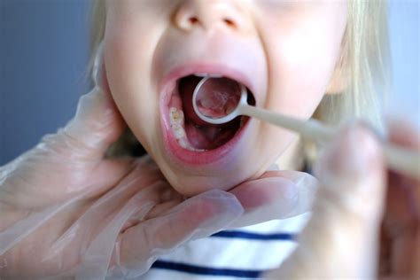 La carie de la petite enfance Soins Dentaires André Gascon