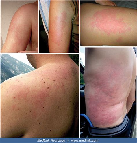 Skin Pattern Of Livedo Racemosa Due To Decompression Sickness MedLink