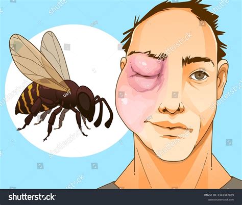 Bee sting. Swollen face. Swollen eye. Injury - Royalty Free Stock ...