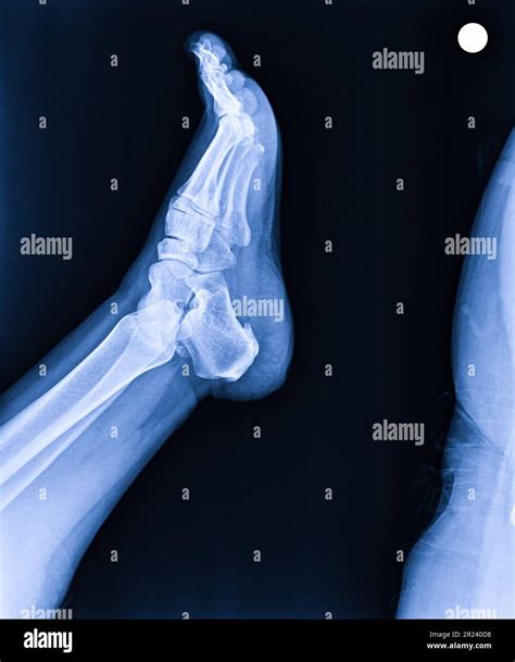 X Ray Normal Human S Foot Lateral Stock Photo Alamy