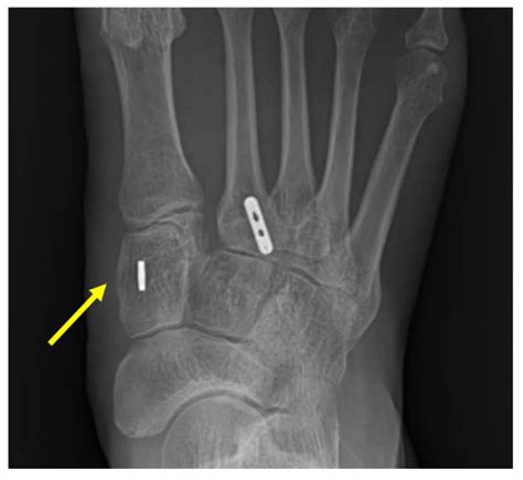 Medicina Free Full Text Various Flexible Fixation Techniques Using Suture Button For