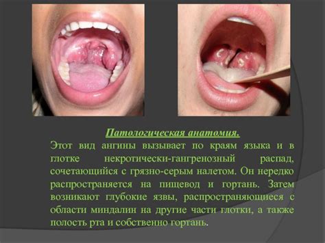 Агранулоцитарная ангина