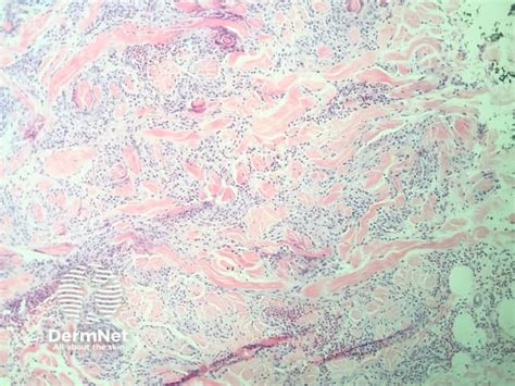 Churg Strauss Syndrome Pathology