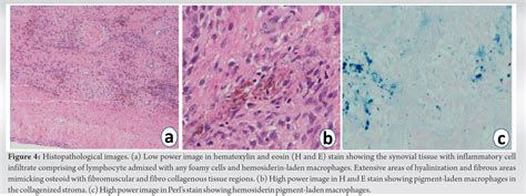 A Novel Technique Of Resecting Localized Pigmented Villonodular