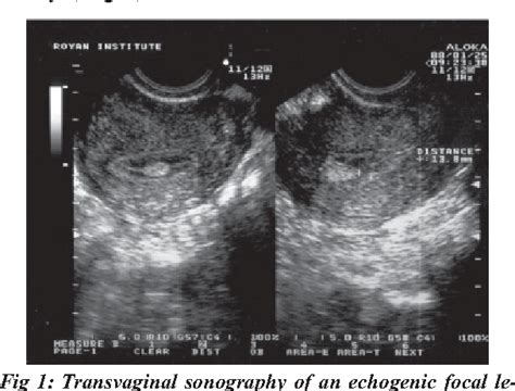 Figure From Diagnostic Accuracy Of Transvaginal Sonography In