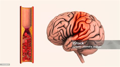 cerebrovascular disease   ischemic stroke stock photo