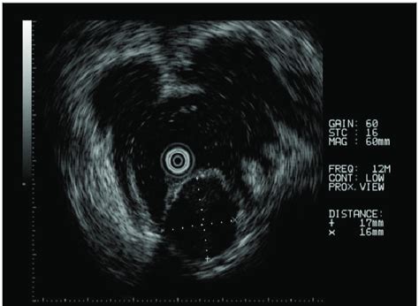 Endoscopic US showing a hypoechoic mass of 17×16 mm in the 4th layer. | Download Scientific Diagram