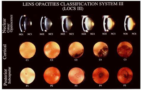 Clasificación LOCS III Tomado de Chylack et al 1993 Download