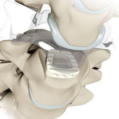 Cervical Interbody Fusion Cage NOVEL CIS Alphatec Spine Anterior