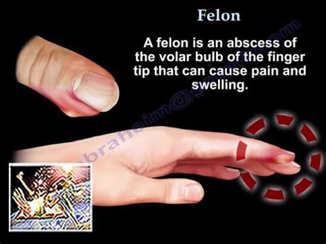 Felon - Everything You Need To Know - Dr. Nabil Ebraheim - YouTube