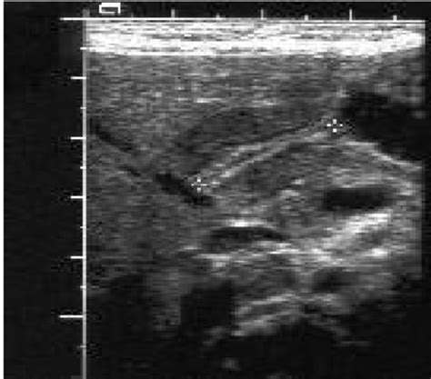 Sonographic measurement of pylorus canal length (Cervix sign in IHPS ...