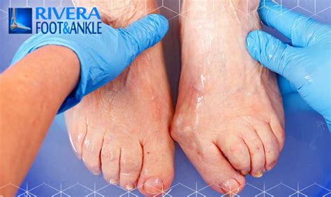 Rivera Foot And Ankle M Dico Especialista En Pie Y Tobillo