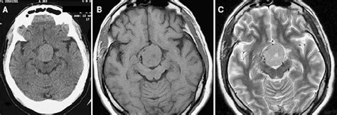 A Axial Ct Scans Show A Homogeneous Hyperdense 45·35 Mm 2 Mass Filling Download Scientific