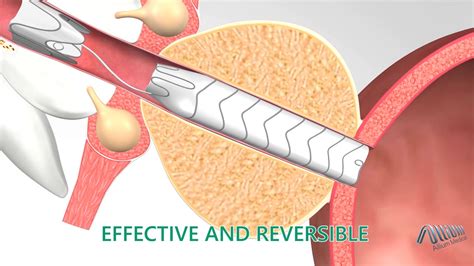 allium medical tps stent  youtube