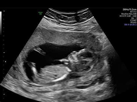 Ultrasonido De 13 Semanas Babycenter
