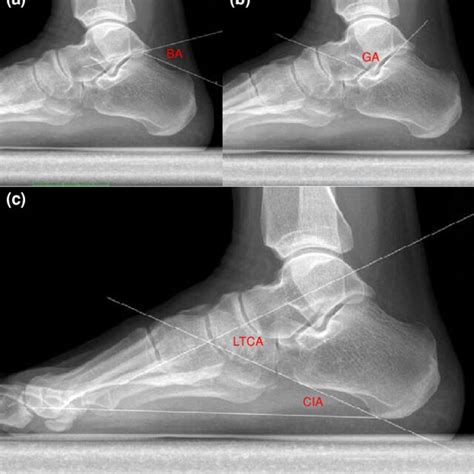 Angles Measured On Weight Bearing Lateral Foot Radiography A Böhler Download Scientific