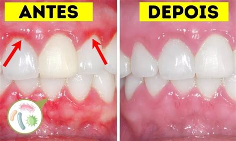 O Que É Bom Para Desinflamar Gengiva - Gengiva Inflamada: Veja Os 5 Melhores Remédios Caseiros – NJHCIG