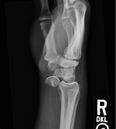 Wrist Dislocation After Motorcycle Crash Sports Medicine Review