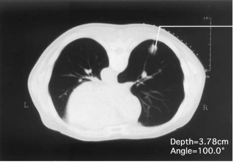 Figure From Use Of Technetium M Tin Colloid For Sentinel Lymph Node