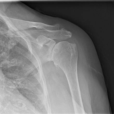 Dr McClintock S Shoulder X Ray Image Gallery Kyle McClintock DO