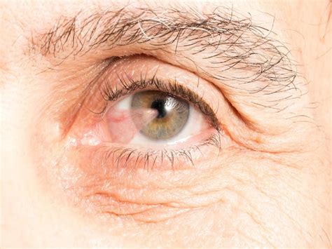 Pterygium Or Surfers Eye Get To Know The Causes And Symptoms