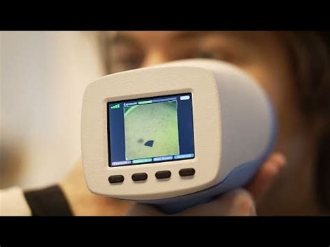 Melanoma Un Nuovo Strumento Per Velocizzare Lo Screening Gloo