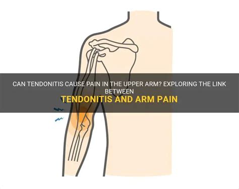 Can Tendonitis Cause Pain In The Upper Arm Exploring The Link Between