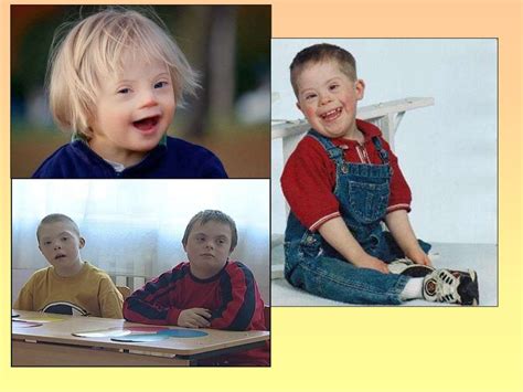 Синдром Дауна - презентация онлайн