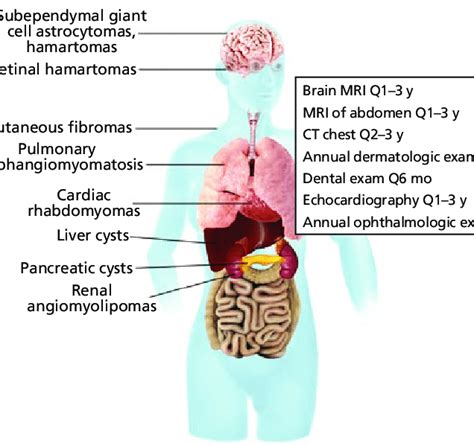 Clinical Manifestations Of Tuberous Sclerosis Complex Tsc Tsc Is An