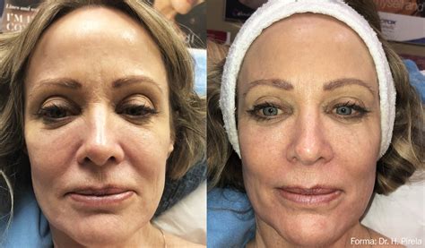 Forma Skin Tightening Forehead Upper Lower Eyelids Jowls Necks