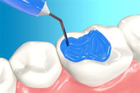 Different Types Of Adhesive Bonding Materials | Industrial Material ...