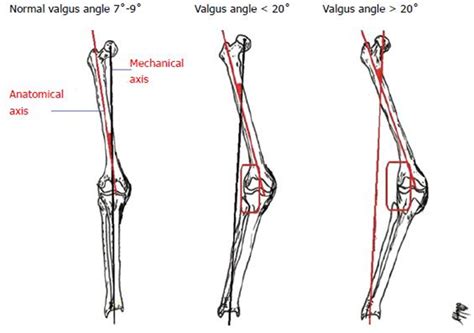 Valgus Definition And Examples Biology Online Dictionary